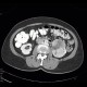 Renal carcinoma, Grawitz tumour: CT - Computed tomography